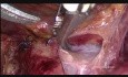 Linfadenectomía pélvica laparoscópica por cáncer de ovario