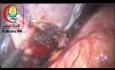 Perforación accidental de la vesícula biliar durante la colecistectomía laparoscópica