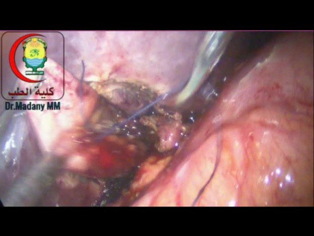 Perforación accidental de la vesícula biliar durante la colecistectomía laparoscópica