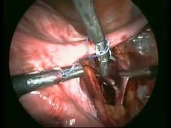 Aislamiento y ligadura de arterias uterinas en su origen