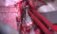 Quiste coloide. Abordaje transcalloso interhemisférico