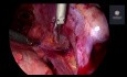 Cirugía de endometriosis profunda 