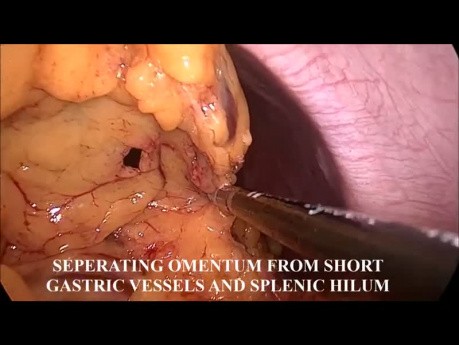 Omentectomía total laparoscópica