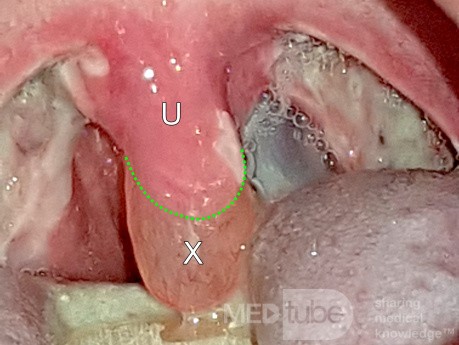 Edema de úvula después de la amigdalectomía