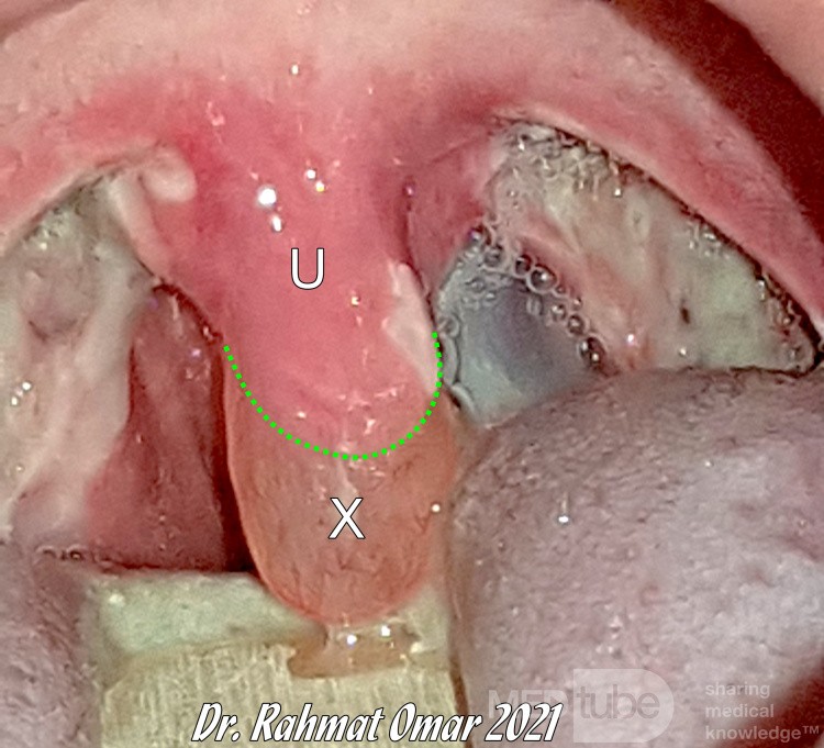 Edema de úvula después de la amigdalectomía