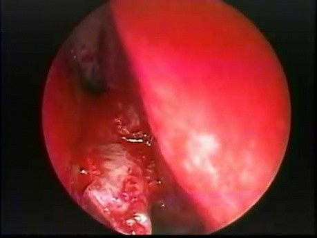 Espolón del tabique nasal - extracción endoscópica