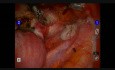 Histerectomía robótica de útero de tamaño de 20 semanas