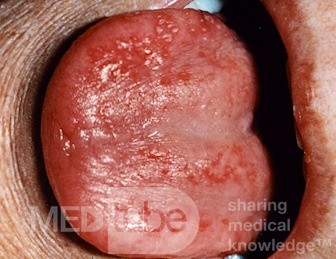 Glositis atrófica