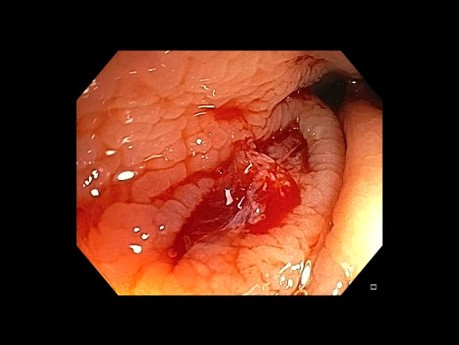 Polipectomía rectal con lazo frío