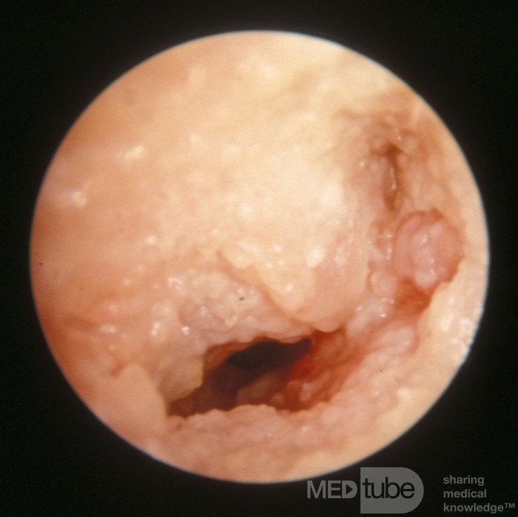 Carcinoma de células escamosas del conducto auditivo externo