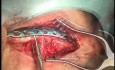 Fractura de clavícula: cirugía de clavícula