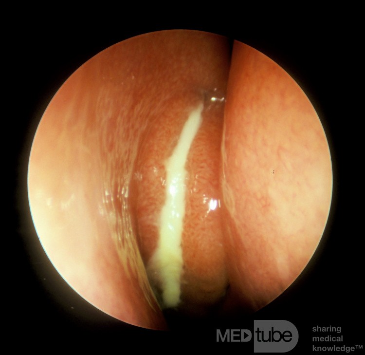 Sinusitis maxilar aguda recurrente [derecha]