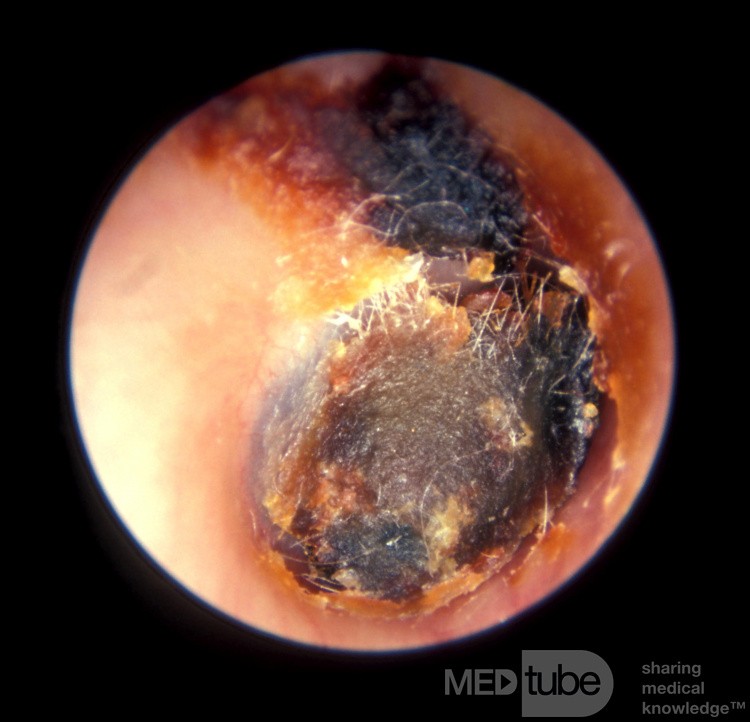 Impresión de cerumen profundamente impactado con aplicador con punta de algodón