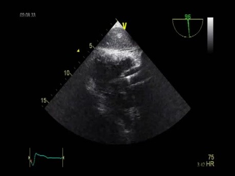 Ecocardiografía - Vista Transgástrica