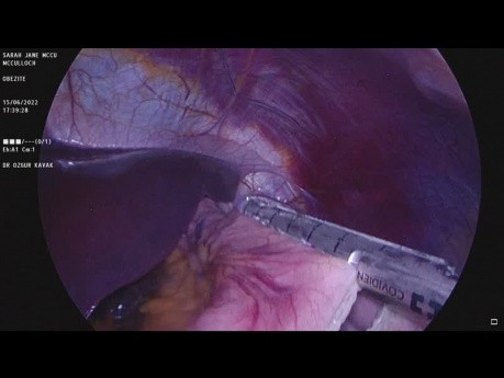 Cirugía de gastrectomía en manga (técnica de 3 llaves, doble capa, sutura)