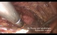 Caso raro: hemivagina obstruida, agenesia renal, útero septado