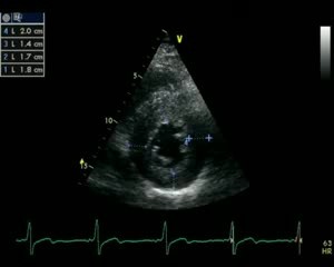 Miocardiopatía hipertrófica