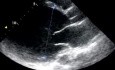 Cardiopatía dilatada 