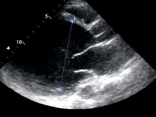 Cardiopatía dilatada 