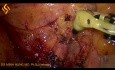 Linfadenectomía laparoscópica del cáncer de colon derecho