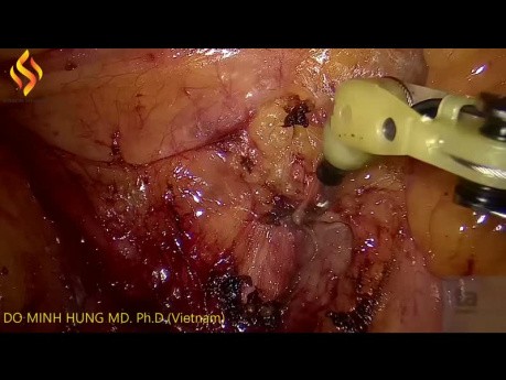 Linfadenectomía laparoscópica del cáncer de colon derecho