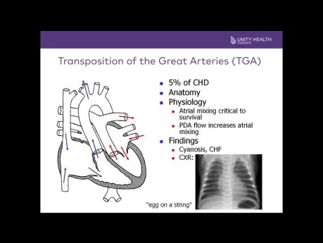 Introducción a los ecocardiogramas pediátricos y los defectos cardíacos congénitos críticos comunes