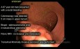 Cirugía transanal mínimamente invasiva (TAMIS) para adenoma maligno T1 del recto proximal