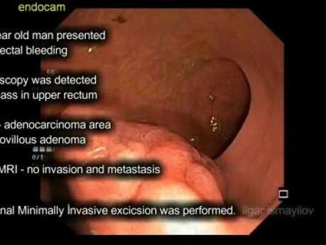 Cirugía transanal mínimamente invasiva (TAMIS) para adenoma maligno T1 del recto proximal