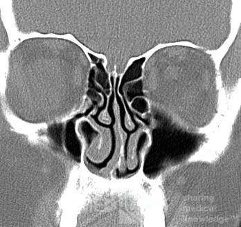 Hipoplasia del seno maxilar tipo 1 [tomografía computarizada]