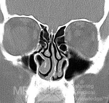 Hipoplasia del seno maxilar tipo 1 [tomografía computarizada]