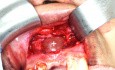 Quiste apical