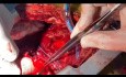 Operación de ACD en hemorragia - cirugía de Bentall