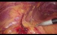 La arteria de Moskowitz y la movilización de flexión esplénica durante la resección sigmoidea laparoscópica 