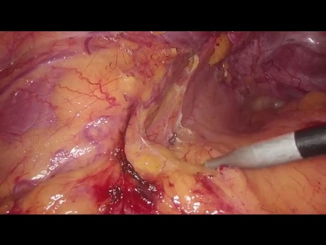 La arteria de Moskowitz y la movilización de flexión esplénica durante la resección sigmoidea laparoscópica 