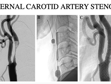 Conferencia sobre Cirugía de los Trastornos Arteriales (Narrado)