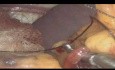 Esplenectomía por laparoscopia para la metástasis esplénica