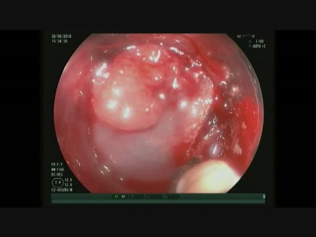 Adenoma de recto residual con varias fibrosis