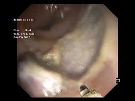 Disección submucosa endoscópica + clipaje del lecho de resección