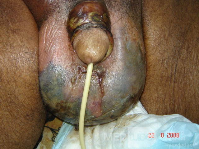 Gangrena de Fournier