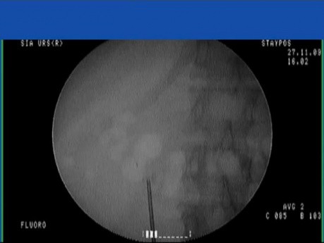 Cálculo renal: extraído con cesta