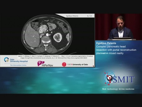 Resección compleja de la cabeza del páncreas con reconstrucción del portal planificada en realidad mixta - SMIT 2019