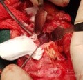 Reseccion total de la lesión a través de un Abordaje lateral fronto órbita cigomatico