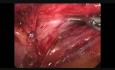 Funduplicatura de Nissen laparoscópica