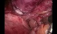Reparación laparoscópica de hernia incisional ventral con malla