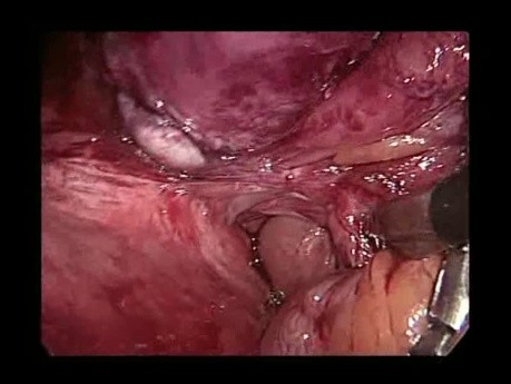 Reparación laparoscópica de hernia incisional ventral con malla