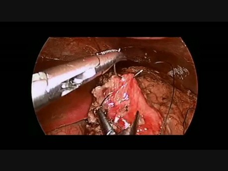 Reparación laparoscópica de perforación gástrica