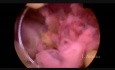 Restos del saco embrional vistos mediante una histerscopia