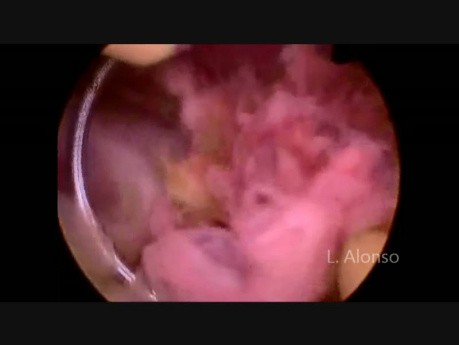 Restos del saco embrional vistos mediante una histerscopia