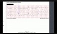 Caso de ECG 2