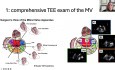 Evaluación ecocardiográfica de la válvula mitral para su reparación